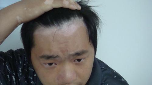 北京治疗白癜风医院：男性白癜风治疗时要避免什么问题